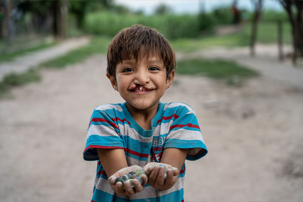 Samir smiling and holding marbles before cleft surgery