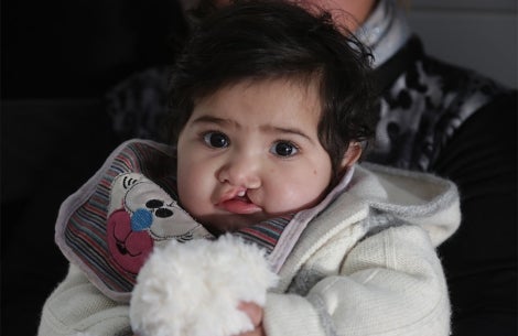 baby with a cleft lip